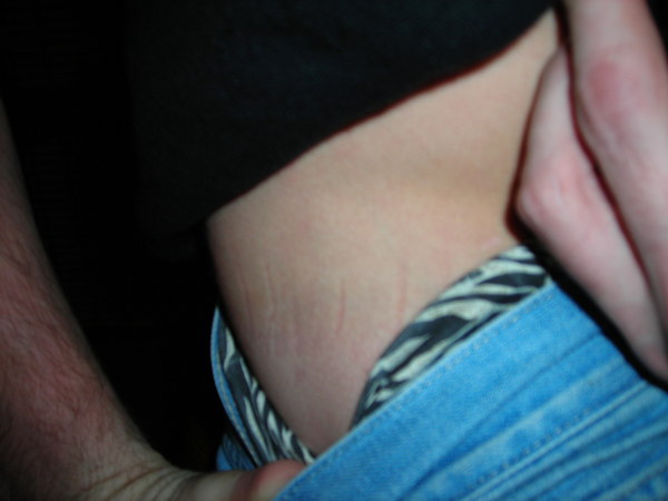 Striae?
